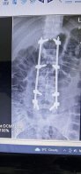 Лікарі Дрогобича успішно прооперували 21-річного мотоцикліста з важкою травмою хребта після аварії.