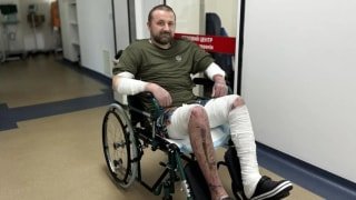У Львові лікарі врятували чоловіка з 80% опіків, використавши біоматеріали тваринного походження